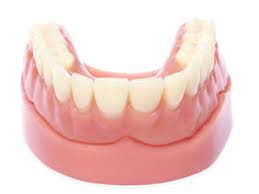 Removable Acrylic Overdenture Dental Implants in Emeryville, CA