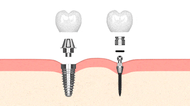 Mini Dental Implants in Emeryville, CA Mini Dental Implant Center
